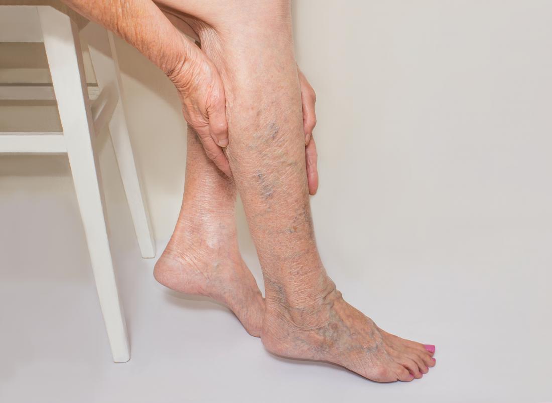 What Are The Common Treatment Options For Varicose Veins?