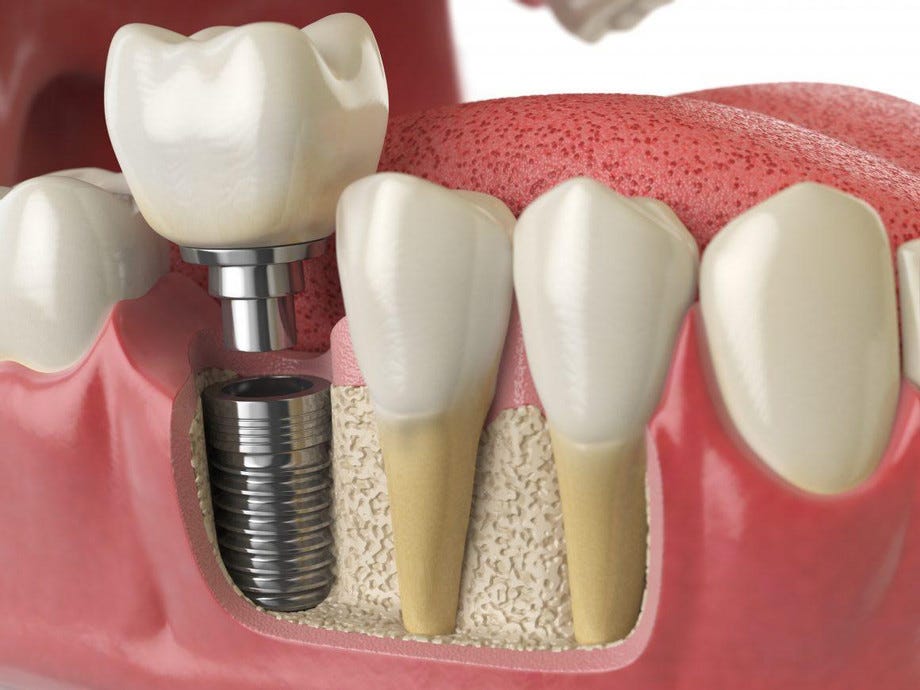 Dental Implants 77027