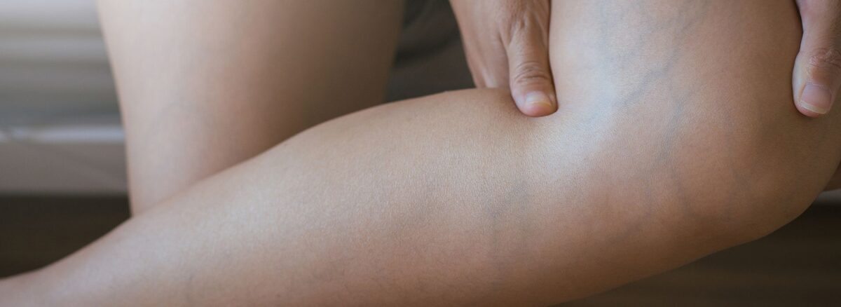 When Should You See A Vascular Doctor? How Much Does Varicose Vein Treatment Cost?