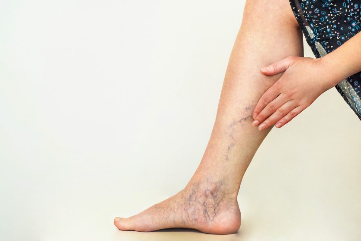 Do Spider Veins Come Back After Laser Treatment? What Type Of Doctor Treats Varicose Veins?