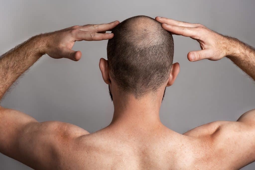 The Complete Guide to Hair Transplantation in Dubai: Unlock Confidence