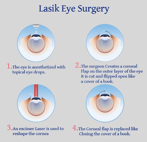 Do corneal nerves regrow after LASIK surgery