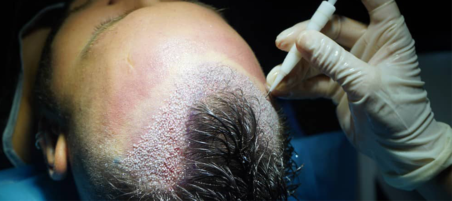 DHI Hair Implantation in Dubai