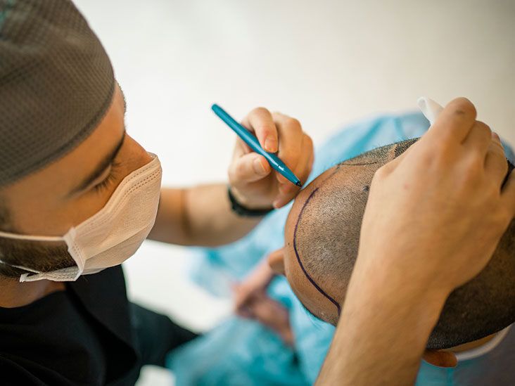 Top 5 Mistakes to Avoid After Getting an FUE Hair Transplant